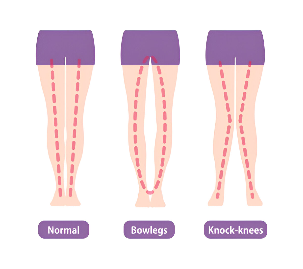 Knock Knees & Bow Legs Treatment In Vashi